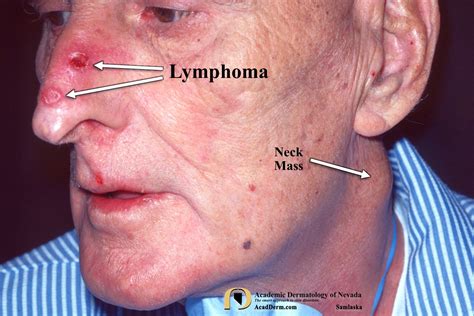 lymphoma images photos pictures|images of plaque skin lymphoma.